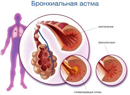 bronhialnaya-astma