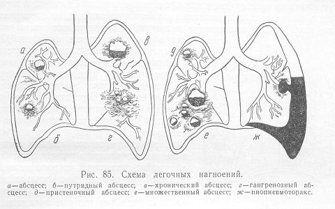 Острый и хронический абсцесс легкого