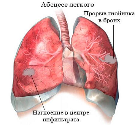 abscess-legkogo