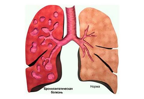 bronkhoektaticheskaya-bolezn